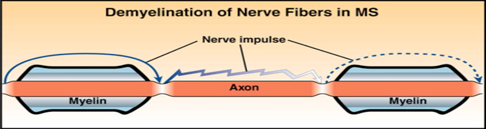 Demyelination in MS