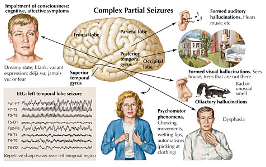 frontal lobe epilepsy symptoms