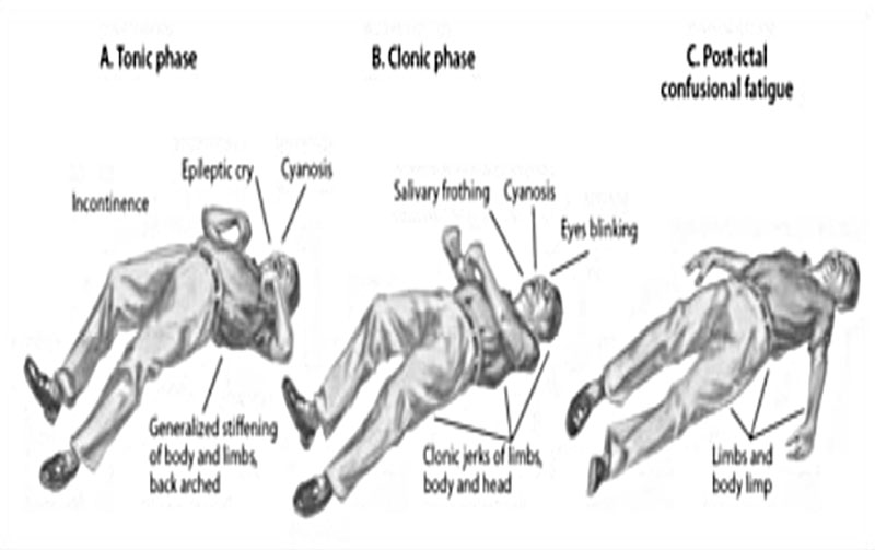 types of seizures