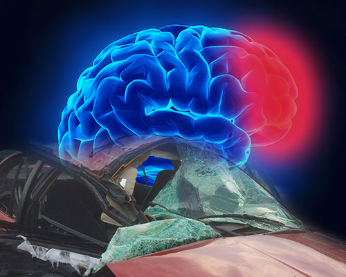 MVA Brain Injury2